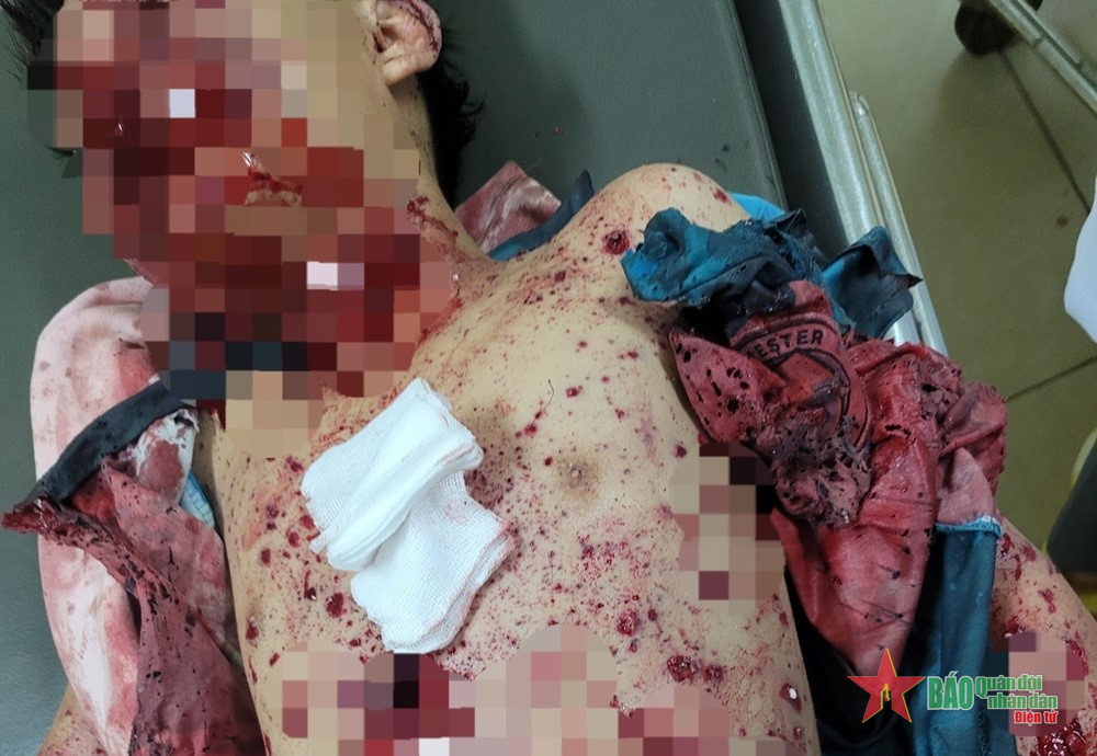 Tự chế pháo nổ, 2 học sinh bị thương nặng